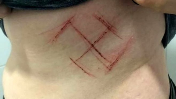 Tatuagem de sangue: agressores usaram canivete para gravar símbolo nazista na barriga da vítima